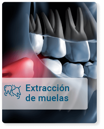 Extraccion-de-muelas.png