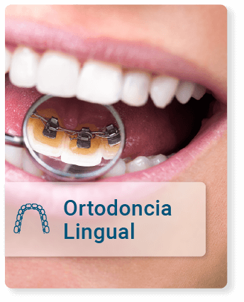 Ortodoncia-lingual.png